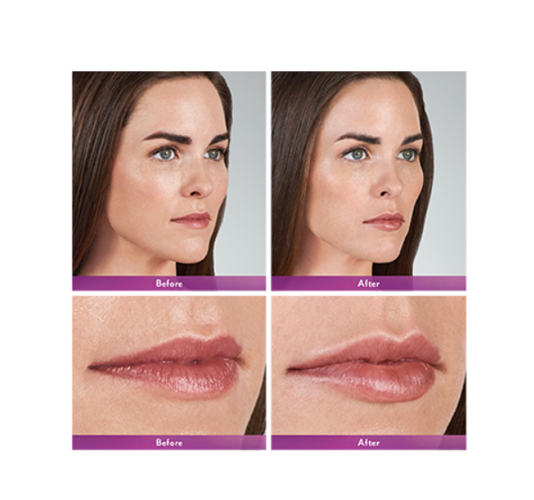 Ultra 3 Ultra 4 Voluma Juvederm Hyaluronic Acid Fillers