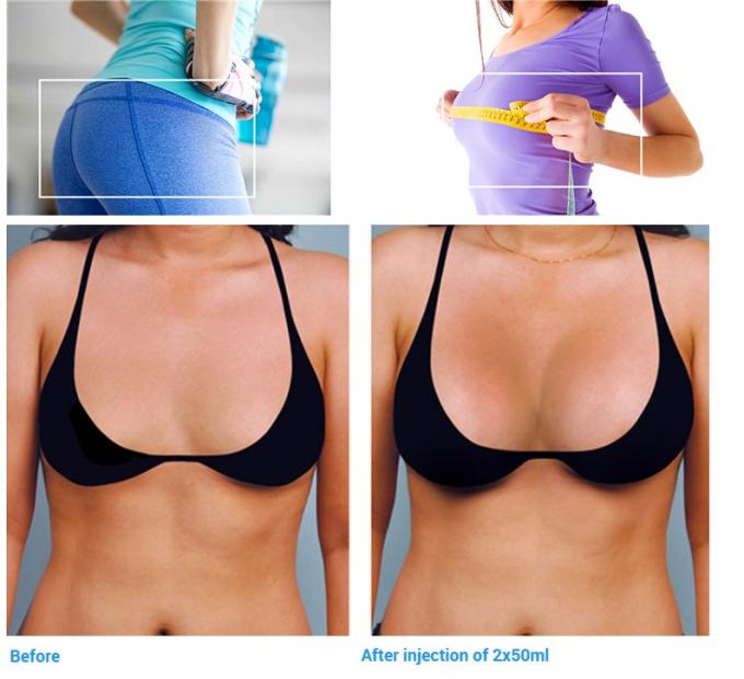 MSDS 20ml Hyaluronic Acid Breast Filler , Hyaluronic Acid Buttock Filler