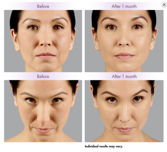 Lip Face Shaping Hyaluronic Acid Dermal Filler Juvederm Ultra4 Voluma