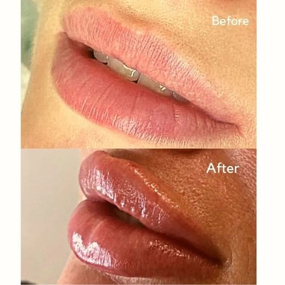 Injectable Filler Injection Juvederms Ultra 3 HA Dermal Filler For Lip Volume
