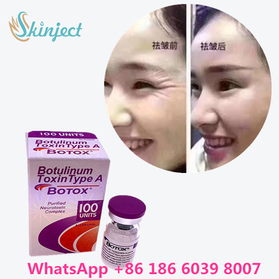 Botulinum Toxin  Wrinkle Removal 100u Allergan 100 Units For Face Lift Injection