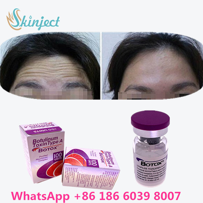 Botulinum Toxin  Wrinkle Removal 100u Allergan 100 Units For Face Lift Injection