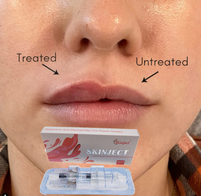 Injectable Deep Hyaluronic Acid Dermal 2ml Lip Filler Cheek Chin Nasolabial Fold