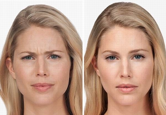 100 Iu Anti Wrinkle Products Korea Botulinum Toxin  Type A