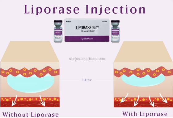 10 Vias Liporase Hyaluronidase For Dermal Filler To Dissolve