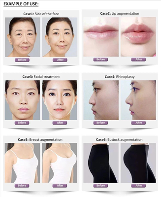 1.1ml Revolax Deep Hyaluronic Dermal Filler For Face
