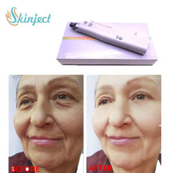 100 Units Type A Botulinum Toxin Powder 2-8°C Storage Temperature