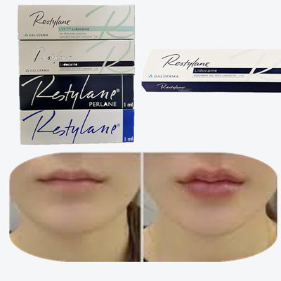 Juvederm Cross Linked Injectable Dermal Filler For Lips