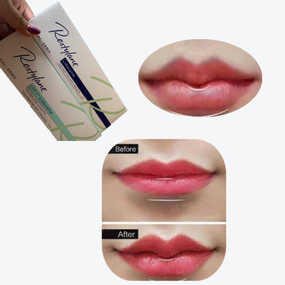 2*1ml/Box Hyaluronic Acid Dermal Filler For Lips Augmentation