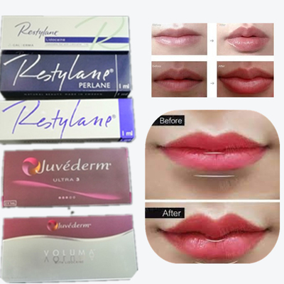 2*1ml/Box Hyaluronic Acid Dermal Filler For Lips Augmentation