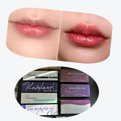 2*1ml/Box Cross Linked Dermal Filler For Lips Augmentation