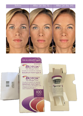 Injections Allergan Botulinum Toxin 100IU Anti Wrinkles Dermal Filler