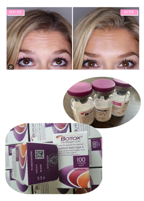 Anti Wrinkle Botulinum Toxin Allergan 100IU 150iu  Injections  ' Na