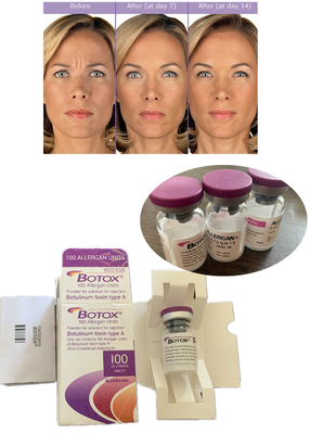 Anti Wrinkle  Botulinum Toxin Allergan 100IU 150iu ' Na