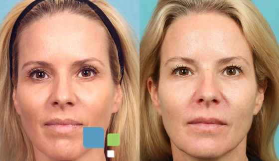 3D PLLA Injection Filler for Face Collagen Regeneration