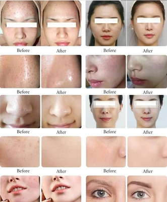 New Arrival Black Pearl 10 In 1 Hydra Peel Machine Microdermabrasion Machine Facial Spa Micro-Touch Hydra Skin Care