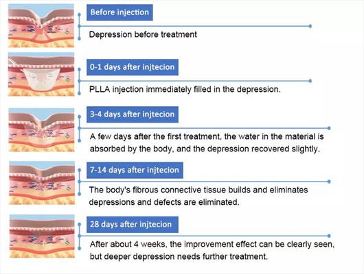 PLLA Poly-L-lactic Acid Facial Injection 10 Vials 150mg