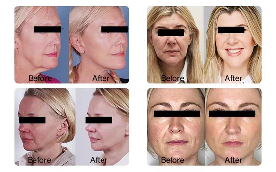 PLLA Poly-L-lactic Acid Facial Injection 10 Vials 150mg