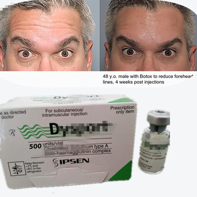 Botulinum Toxin Dysport Anti-Wrinkle Powder Freeze-Dried Powder For Glabellar Lines