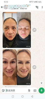 Cosmetic Dysport 500 Units Botulinum Toxin 500 IU Powder For Injection