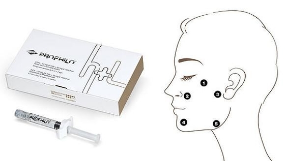 Collagen Stimulation Profhilo Injectable Dermal Filler Five Point Lifting