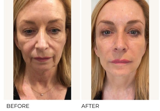 Anti-aging And Wrinkle Removal Profhilo H L 2ml Hyaluronic Acid With 32mg/Ml Ha Concentration