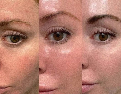 Long Lasting 62mg 2ml Injectable Dermal Filler Profhilo H+L Sodium Hyaluronate