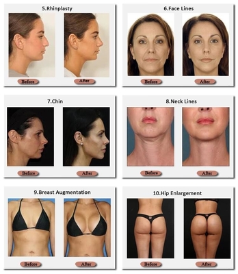 24 mg/ml Non-Surgical Pure Hyaluronic Acid Breast Augmentation Filler