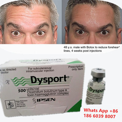 Botulinum Toxin A Dysport Injection For Lip Lines