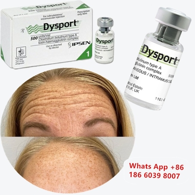 Dysport Botulinum Toxin Type A for Tear Trough Wrinkles