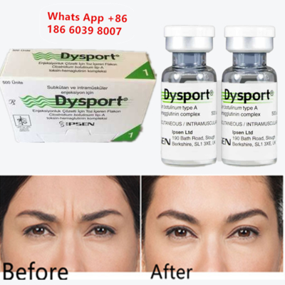 Botulinum Toxin Type A Dysport Injection for Wrinkle Reduction