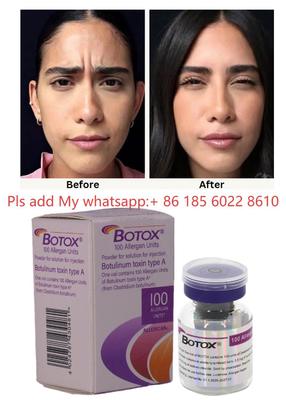 Botulinum Toxin Allergan Botox 100IU Injection-Reduce Aging Signs with Allergan