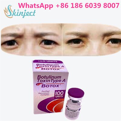 Botulinum Toxin ALLERGAN Duration 4 to 6 Months 100 Units Type A