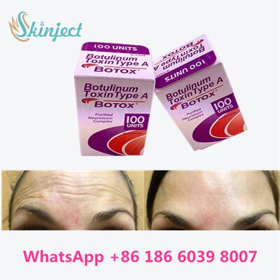 Allergan Botox Botulinum Toxin Type A 100 Units for Wrinkle Removal with 4~6 Months Duration