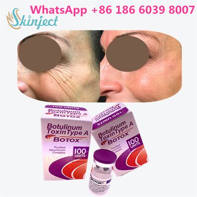 Allergan Botox Botulinum Toxin Type A 100 Units for Wrinkle Removal with 4~6 Months Duration