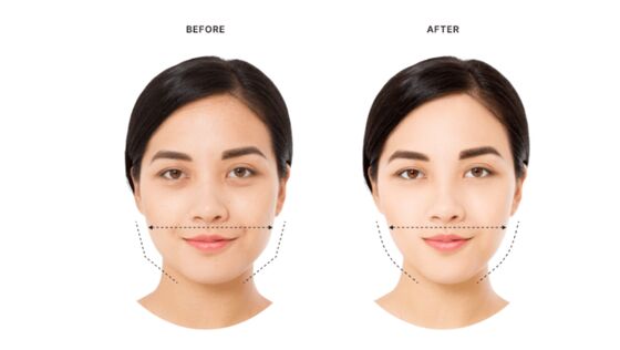 Allergan Botulinum Toxin 100u Injectable Type A Treatment Fine Lines Reduce Wrinkles Lift Facial