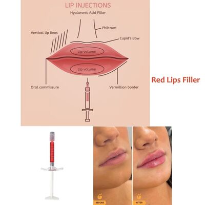 Customization 1ml 24mg/Ml Red Lip Filler Injection Lip injections