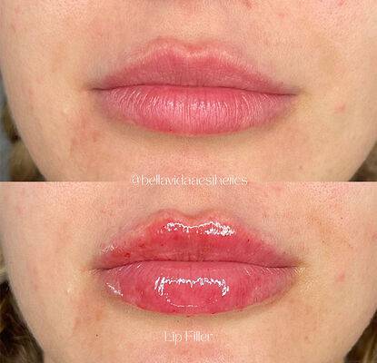 Red Lip Fullness Dermal Filler Injection For Salons Clinics And Aethetics