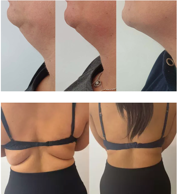 Lemon Bottle Lose Weight Lipolytic Solution for Double Chin, Belly