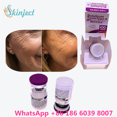 Botulinum Toxin Allergan Botox White Powder Effective Treatment for Facial Lines and Muscle Relaxation in Medical