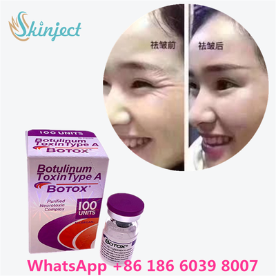 Botulinum Toxin Allergan Botox White Powder Effective Treatment for Facial Lines and Muscle Relaxation in Medical