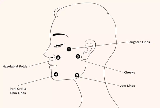 Profhilo Treatment Hyaluronic Acid Skin Booster & Bio-Remodelling