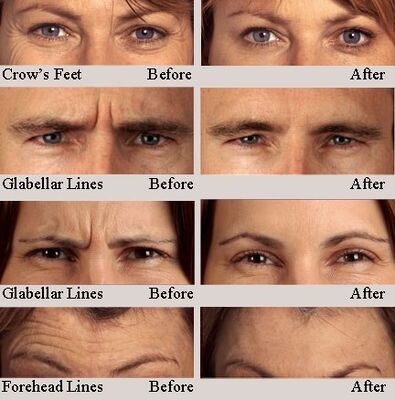 Hyamely Premium Botulinum Toxin Type A for Injection