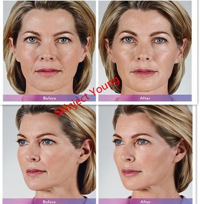 Juvederm Voluma 2x1ml Hyaluronic Acid Injectable Gel Fillers