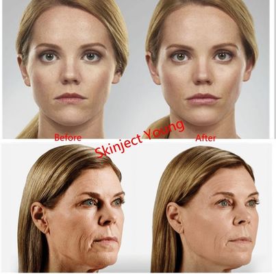 Juvederm Voluma 2x1ml Hyaluronic Acid Injectable Gel Fillers