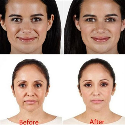 Juvaderm Voluma Hyaluronic Acid Pen Filler For Forehead Eyes Wrinkles