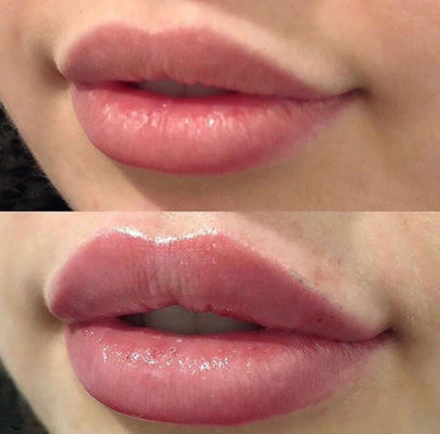 Russian Lips Juvederm Ultra 3 With  Cross Linked Dermal Filler