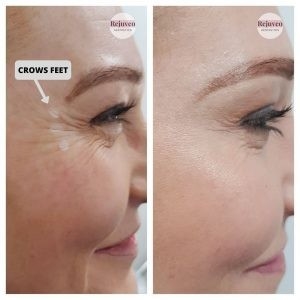 2.5ml Saline Injection Botulinum Toxin Anti Aging 