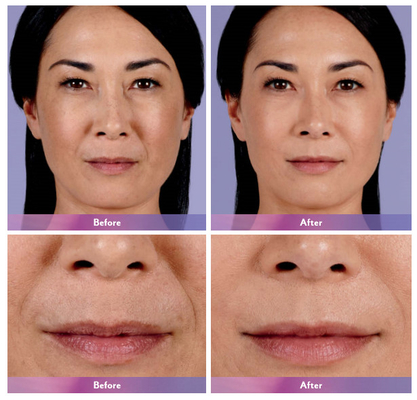 Juvederm Dermal Filler Lip Injection Ultra 4 For Lip Enlargement