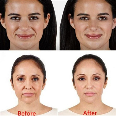 Plastic Dermis Hyaluronic Acid Dermal Filler Juvederm HA Injection For Ladies